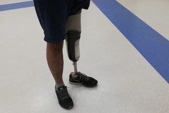 Lower Limb Prosthetic by OPC Care