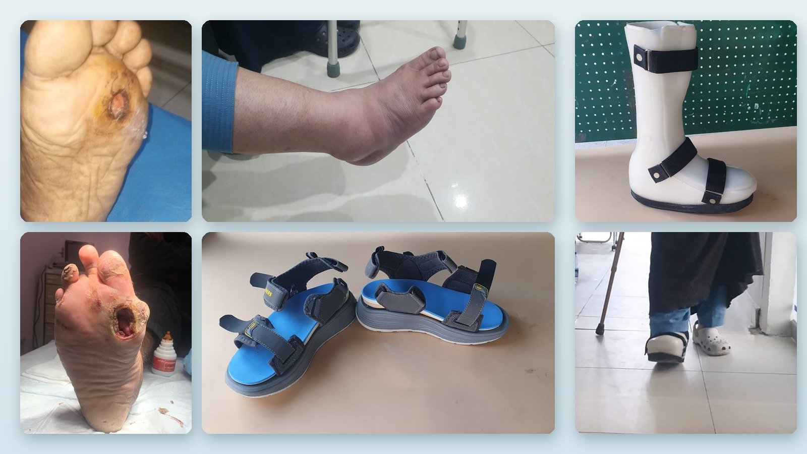 Diabetic Foot Complications and Orthotic Solutions: Protecting Your Feet and Preventing Amputation