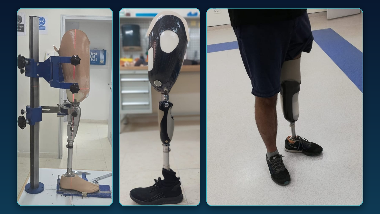 How Proper Prosthetic Fitting Affects Recovery After Limb Loss